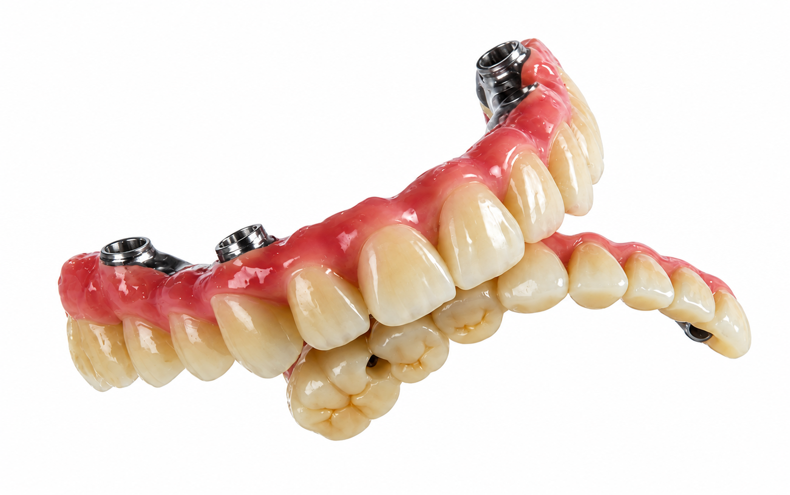 RDL Dental Lab All on 4/6 full arch restorations