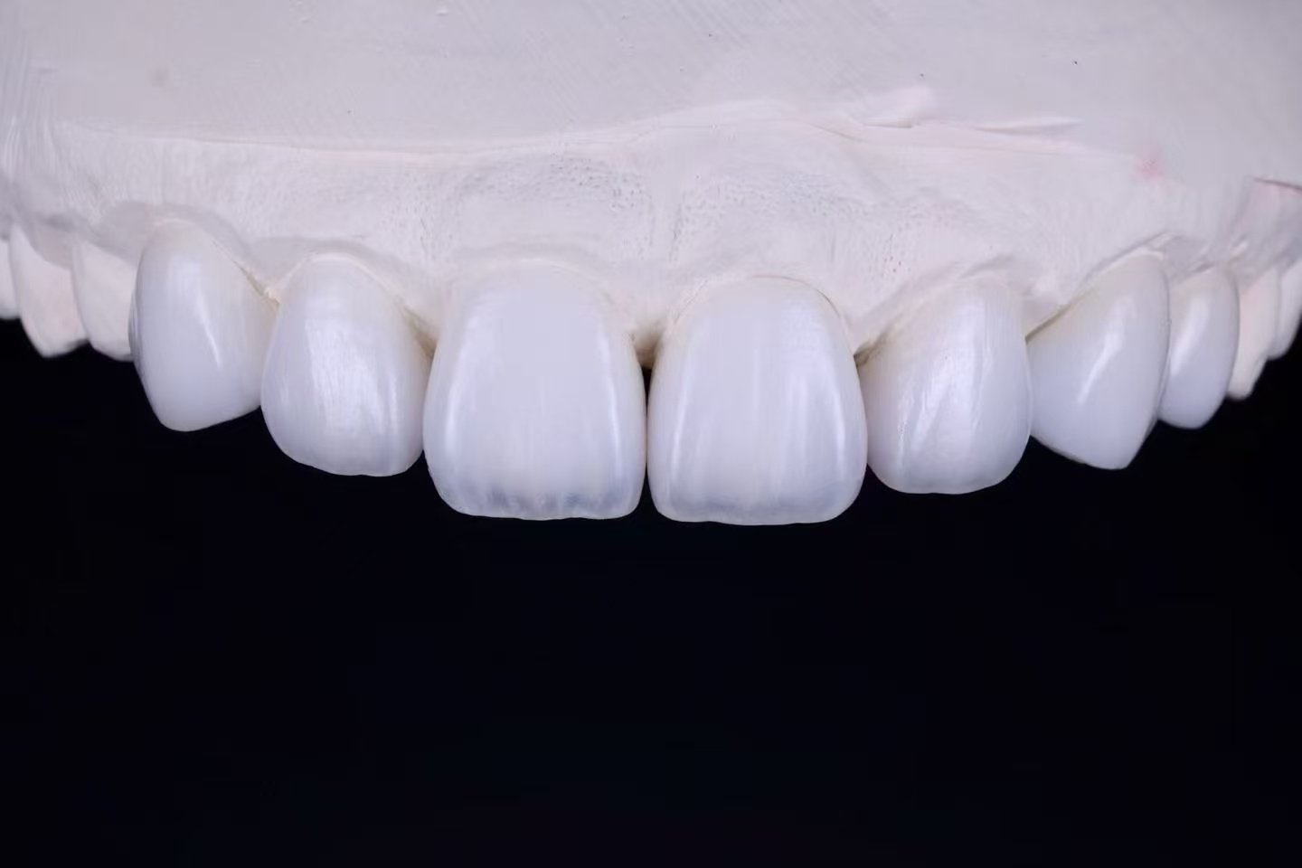 RDL dental restoration example 1