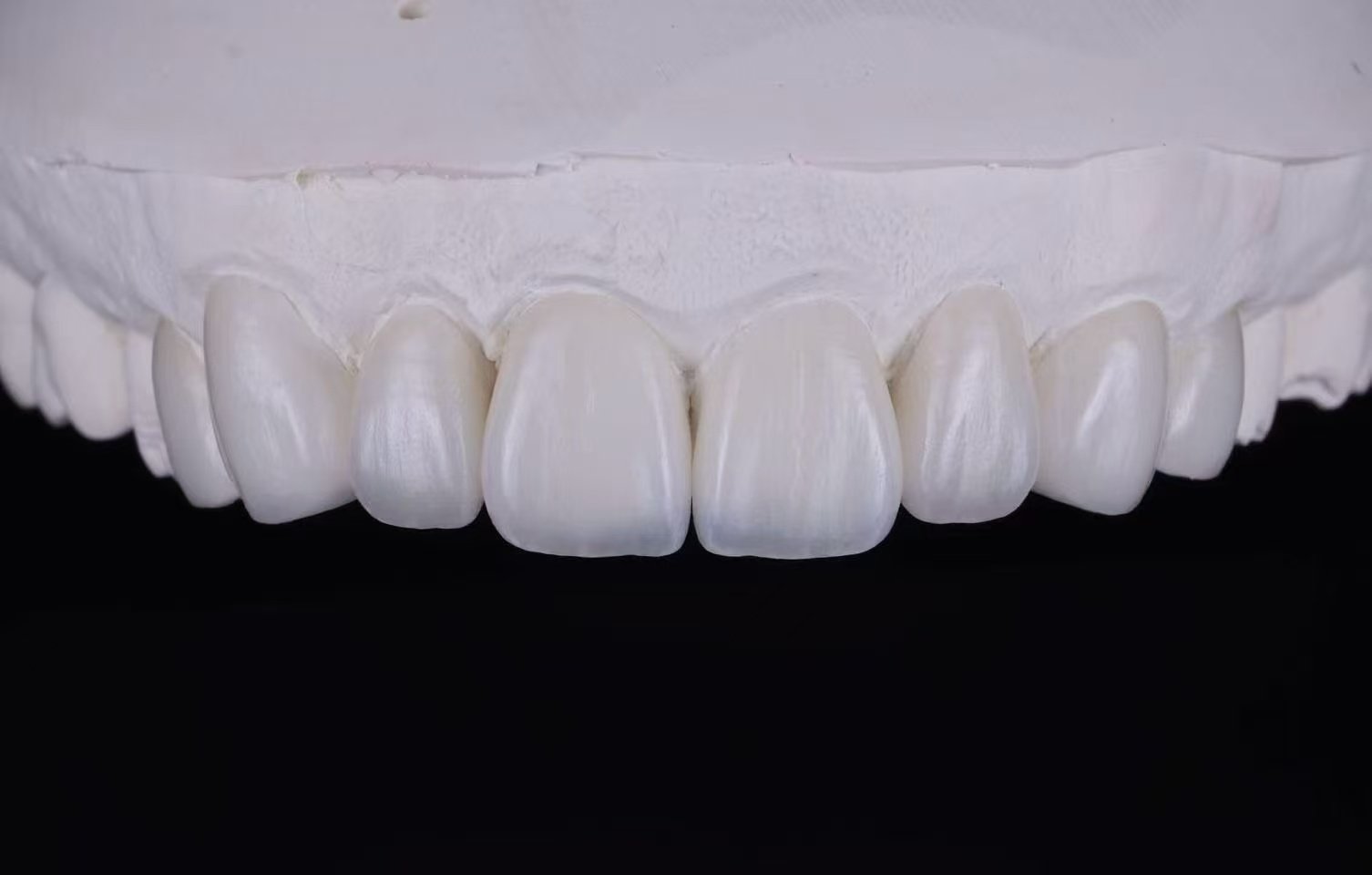RDL dental restoration example 2