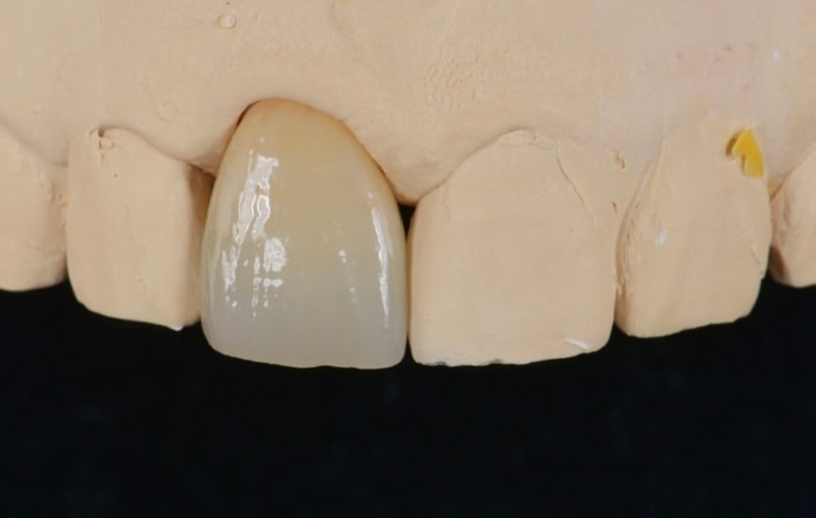 RDL dental restoration example 4