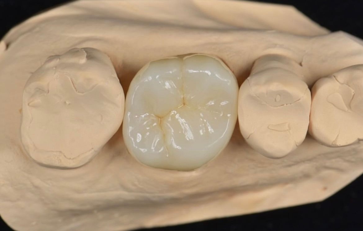 RDL dental restoration example 5