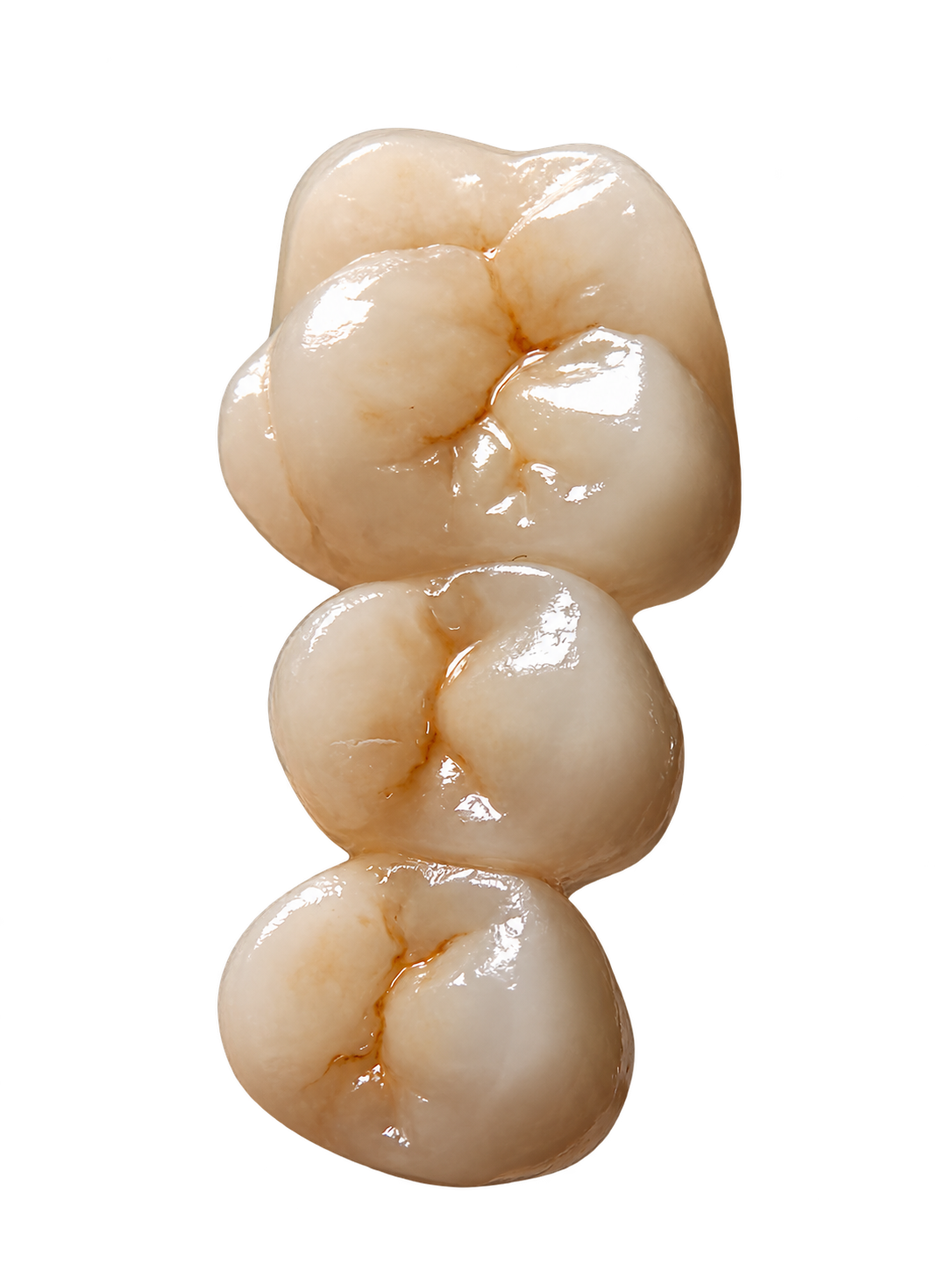 RDL Dental Lab Zirconia Bridge product example