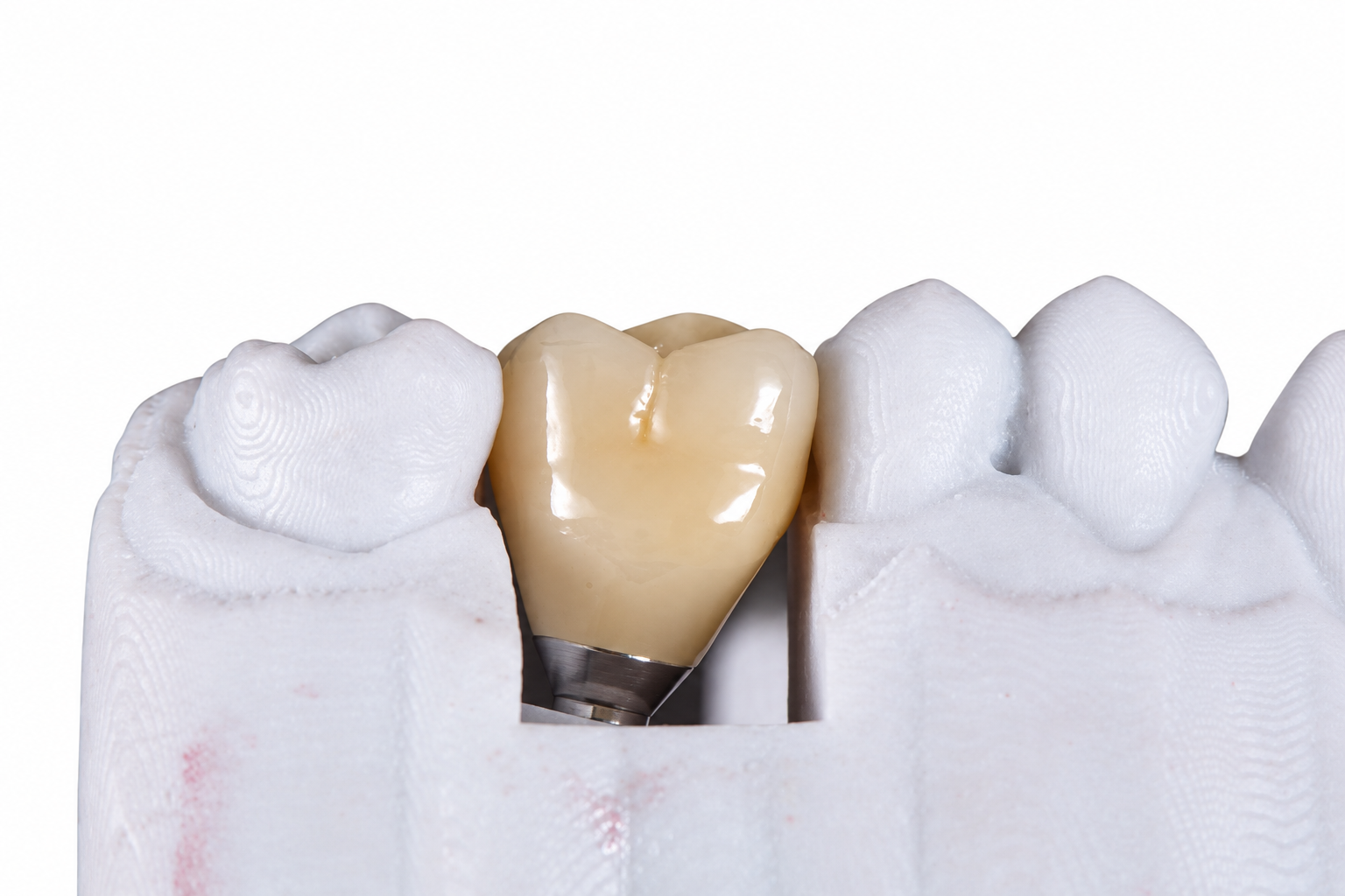 RDL Dental Lab Zirconia Implant product example